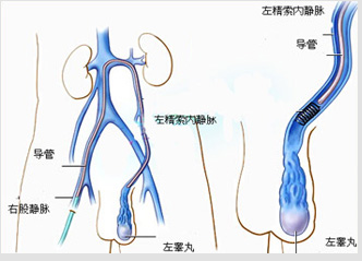 外环下显微精索静脉结扎术
