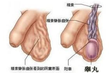 治疗精索静脉曲张的方法哪个好?