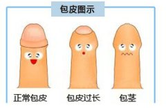 包皮过长“害人害己”