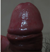 龟头有异味流脓怎么回事？
