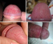 龟头红点有异味是性病吗